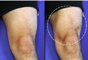 Knee arthritis exercises - quadricep setting . 