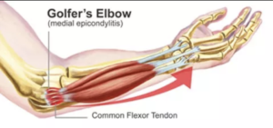Golfer's Elbow Physio - Total Restore