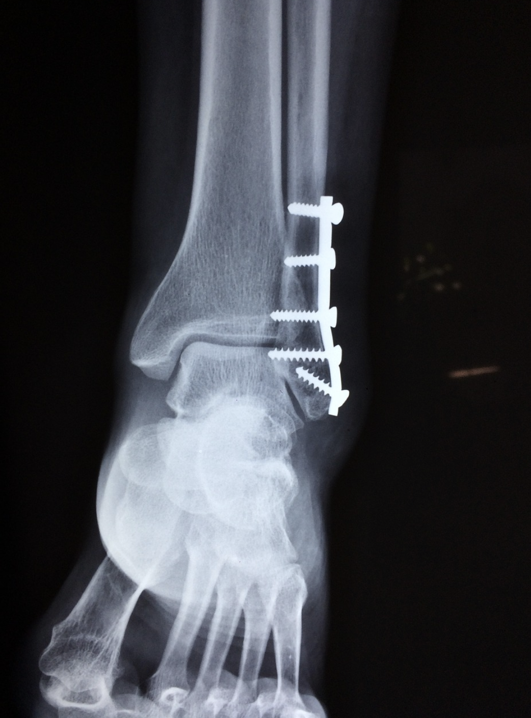 Fracture Treatment In Manchester - Total Restore Physiotherapy