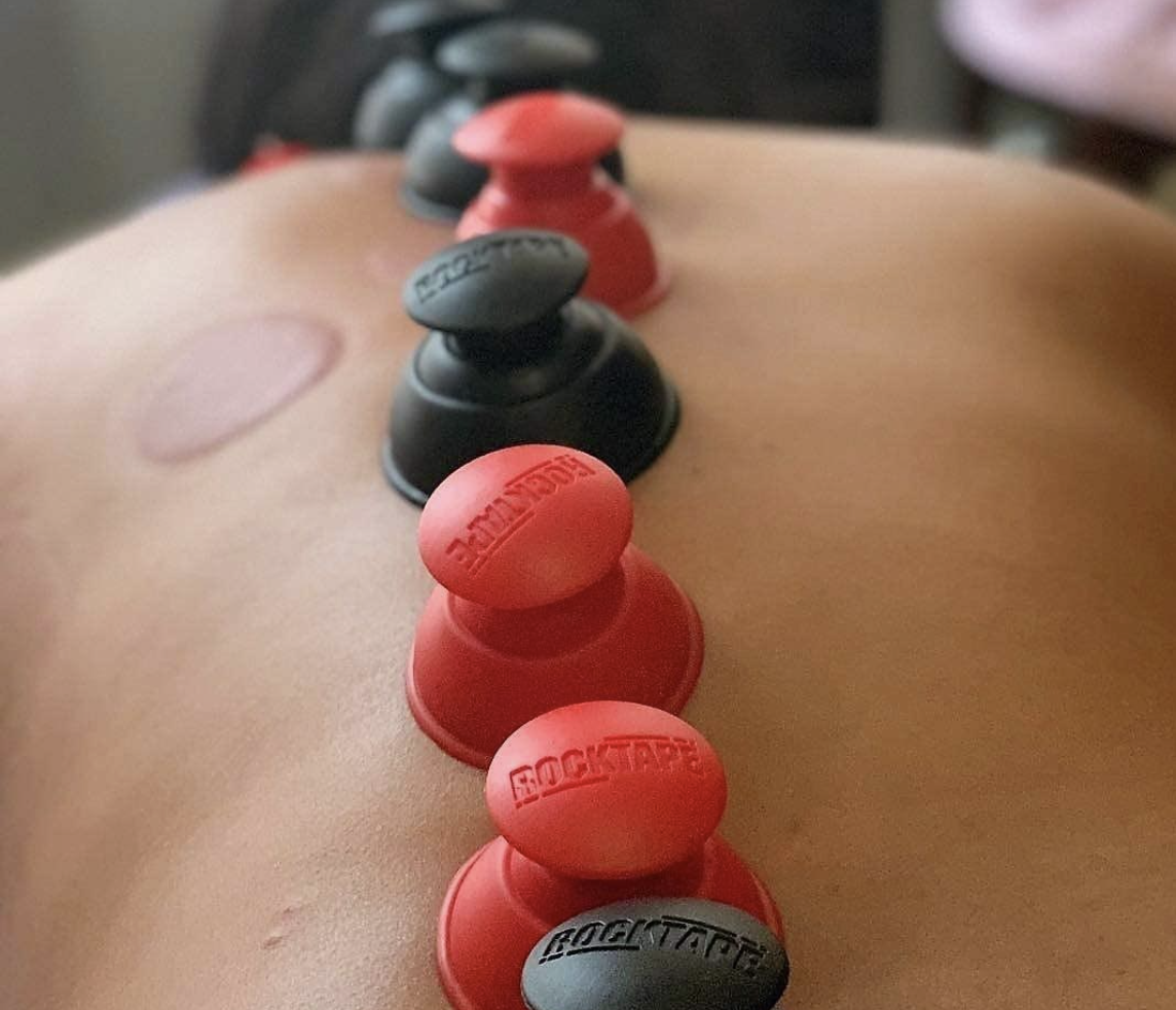 Functional Cupping Therapy and its benefits.